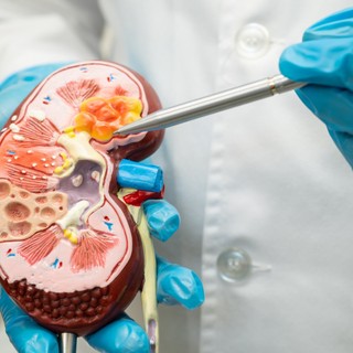 Mitől alakul ki a vesekő? című cikk nyitóképe