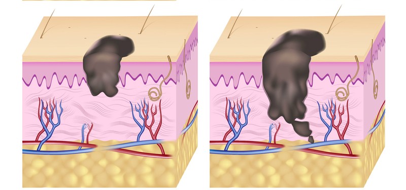 Kamerával szúrja ki a bőrrák korai tüneteit ez a mesterséges intelligencia