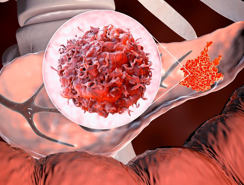 daganatos betegség rák tumor hasnyálmirigy gyulladás 