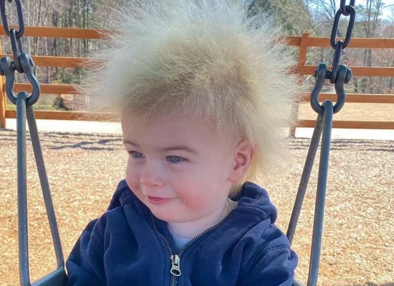 Fésülhetetlen haj szindróma: ennek a kisfiúnak különleges hajszálai vannak