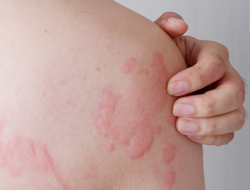 krónikus csalánkiütés tünetek, okok