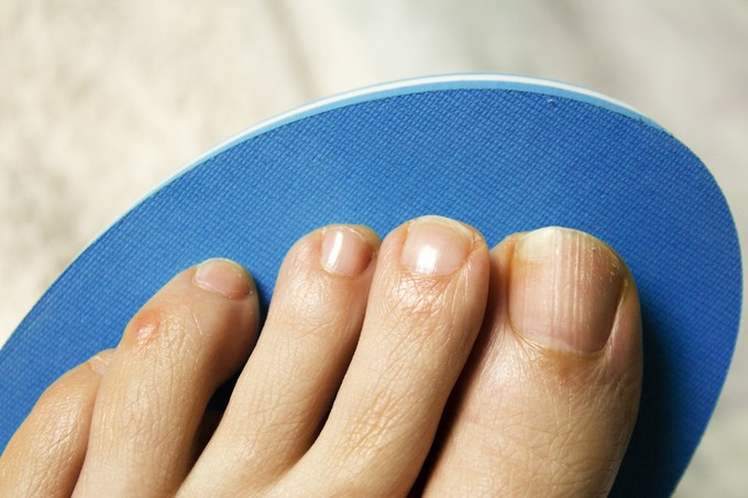 Körömgombát talált néhány ujján? Ezeket a házi módszereket próbálja ki című cikk nyitóképe