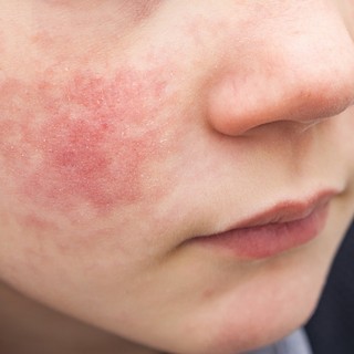 Rózsahimlő, skarlát vagy lepkehimlő? Így különböztesse meg a kiütéses betegségeket című cikk nyitóképe