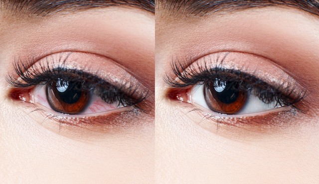 Viszkető, vörös szemek? Így tud védekezni ellene!