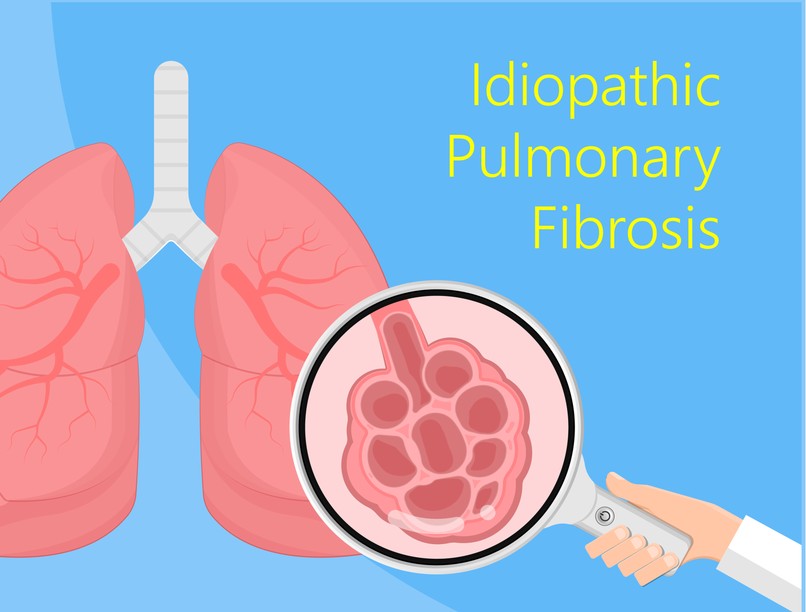 idiopátiás tüdőfibrózis, IPF, tünetei, kezelése, diagnosztizálása, köhögés