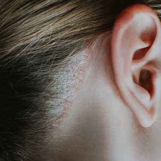 A pikkelysömör kezelése - ezek a módszerek segíthetnek című cikk nyitóképe