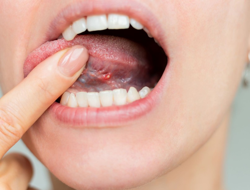 B-vitamin-hiány B12 száj nyelv tünet