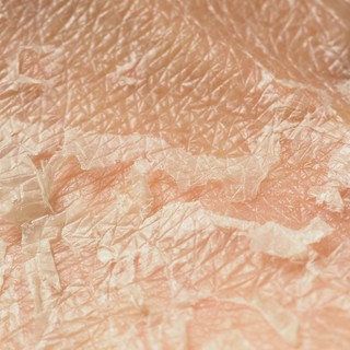 Bőrsérülés (bőrgyulladás, bőrirritáció, sebek) tünetei, vizsgálata és kezelése című cikk nyitóképe