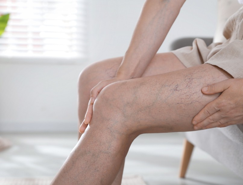 trombózis után mit, hogyan, otthon