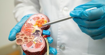 Wilms-tumor: tünete, vizsgálata és kezelési lehetőségei