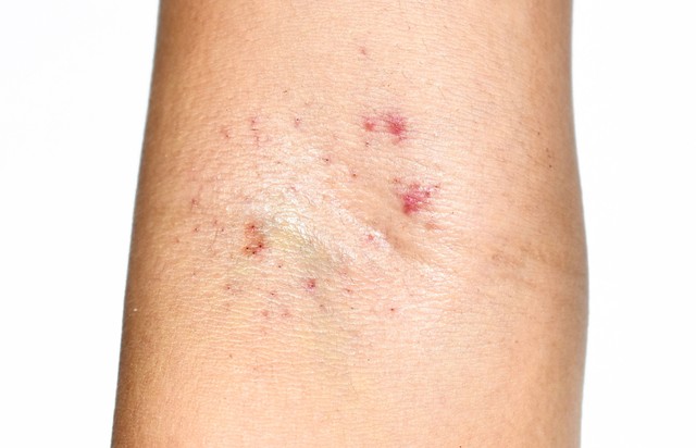 Leukémia - ilyen külső tünetek jelezhetik