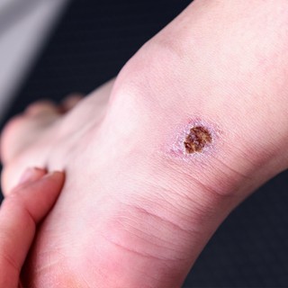 Mit jelent a sebgyógyulási zavar? című cikk nyitóképe