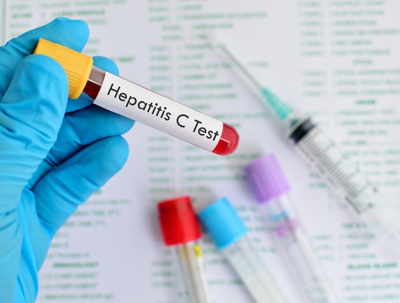 hepatitis c