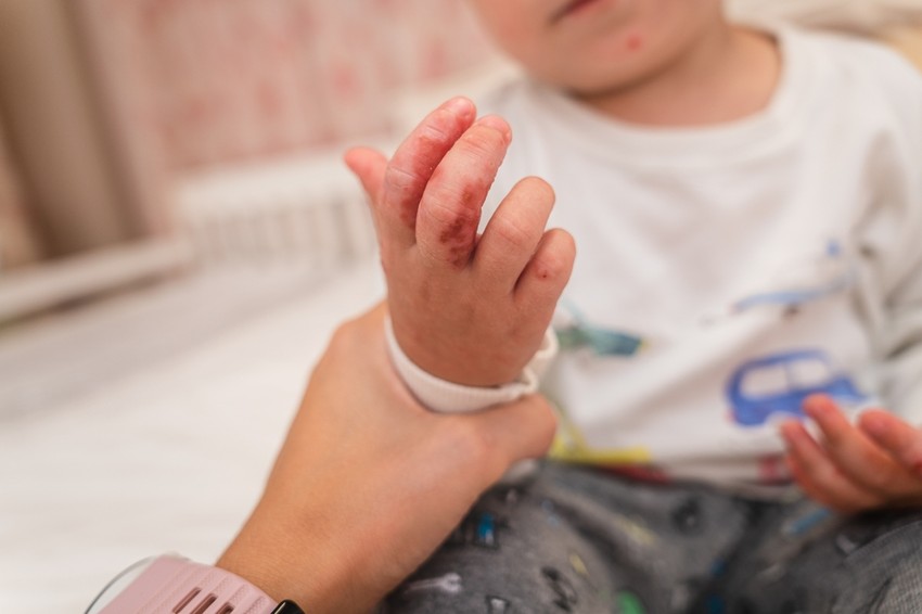 Csecsemők és kisgyermekek első fertőzése fájdalmas fekélyekkel járhat.