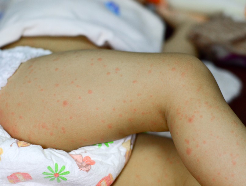 A bárányhimlő tünete és kezelése