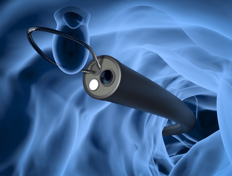 vastagbél rák daganat tünet szűrés vizsgálat