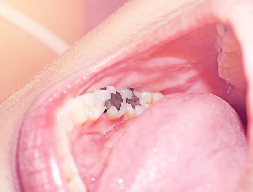 veszélyes nehézfém, amalgám, fém, mérgezés, méregtelenítés, humicin