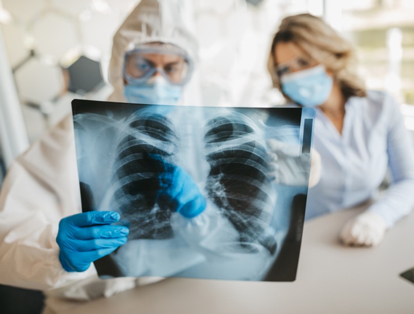 koronavírus, covid-19, tüdő, fertőzés