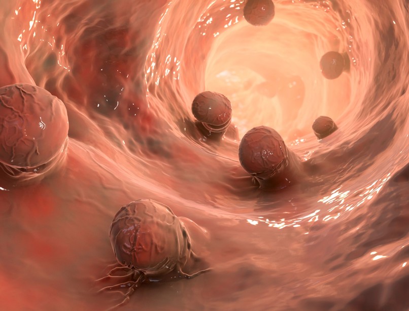 vastagbélpolip, veszélyes tünet rák