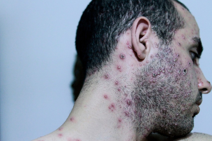 A majomhimlő okozta kiütések gyakran az arcon jelennek meg először, majd átterjednek az egész testre, beleértve a nemi szerveket is. A kiütések különböző fejlődési szakaszokon mennek keresztül, mielőtt végül varasodnak és leesnek. Ekkor a beteg már nem fertőz. A fő különbség a himlő és a majomhimlő tünetei között az, hogy a himlő a majomhimlővel ellentétben nem okozza a nyirokcsomók megduzzadását. 