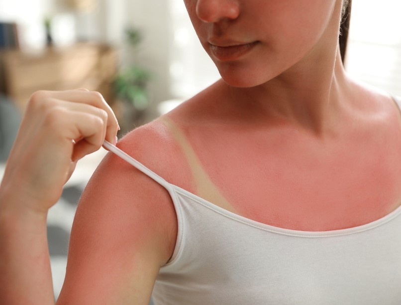 napégés, napégés ellen, D-vitamin, napozás