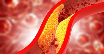  A gyógyszerész ezeket ajánlja, ha szeretné csökkenteni a koleszterin szintjét 