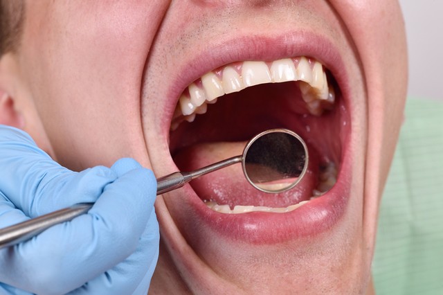 Miért ég a szájpadlásom a fogorvos után?