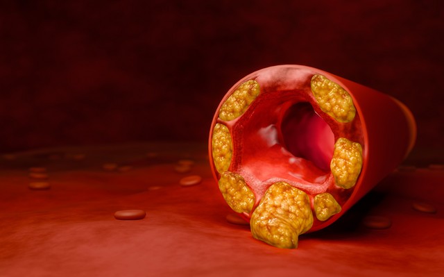 Magas koleszterin ellen a gyógyszer mellett ez is rengeteget segít!