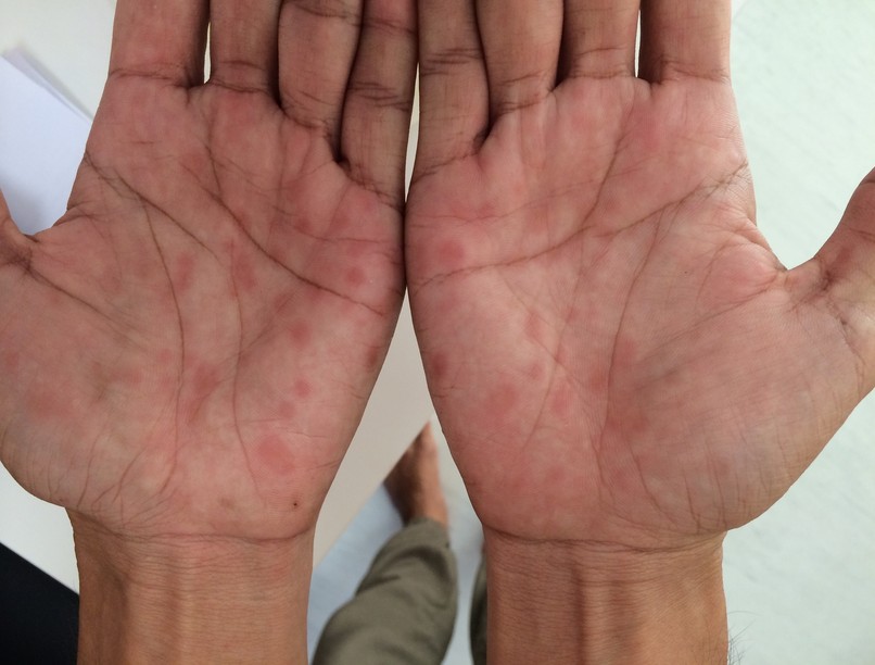 szifilisz nemi betegség tünet