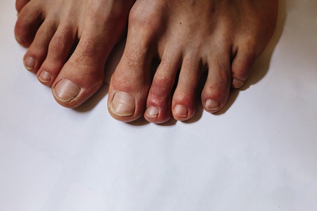 Koronavírus: így néz ki a covid lábujj