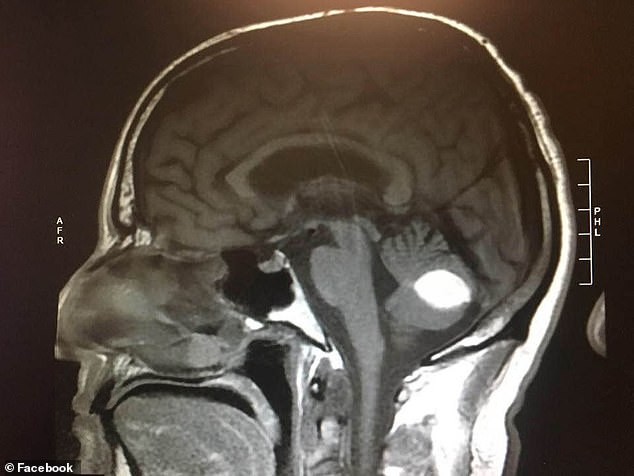  A felvételen látható a daganat - jobb alsó sarokban egy fehér, kerek folt.