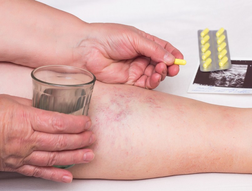 véralvadásgátló gyógyszer vérrög