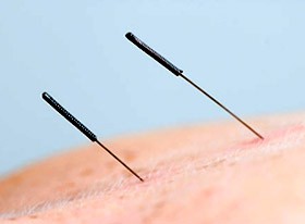 MRI az akupunktúra hatása mellett!