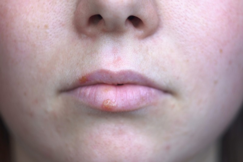 A herpesz két arca: így kapcsolódik az ajakherpesz és a genitális herpesz