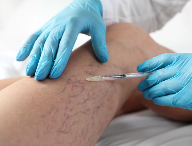 műtéti beavatkozás visszér műtét szkleroterápia kiújul