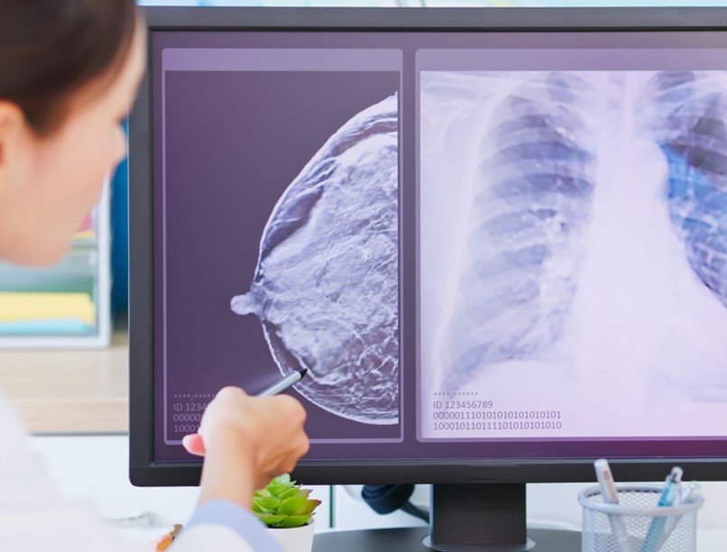 mellrák, emlőrák, hormonpozitív mellrák, rák elleni vakcina, kutatás, vakcina, rákkezelés