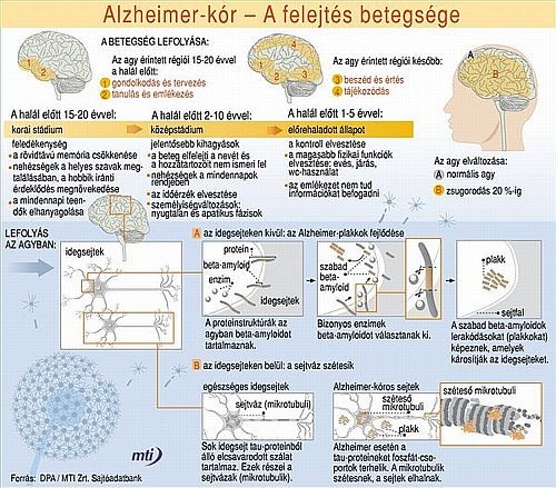 Alzheimer-kór: A felejtés betegsége