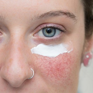 Rosacea és UV sugárzás: hogyan védekezzünk? című cikk nyitóképe