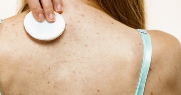  Akné a háton: mitől alakulhat ki, és mit lehet tenni ellene? 