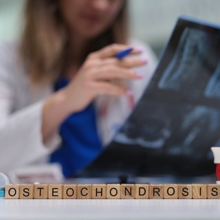 Oszteokondróma: tünetek, vizsgálatok és kezelési lehetőségek című cikk nyitóképe