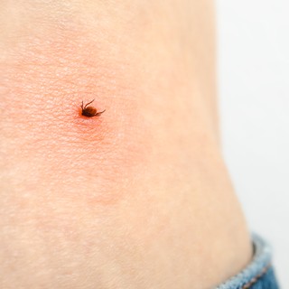 Endometriózis és Lyme-kór: így függ össze a kettő betegség című cikk nyitóképe