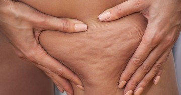 Lipödéma vagy cellulit? Sokan összekeverik, pedig nem ugyanaz