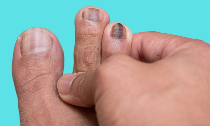 Ha ilyen csíkokat lát a körmén, mutassa meg orvosnak, mert melanómát jelezhet! című cikk nyitóképe