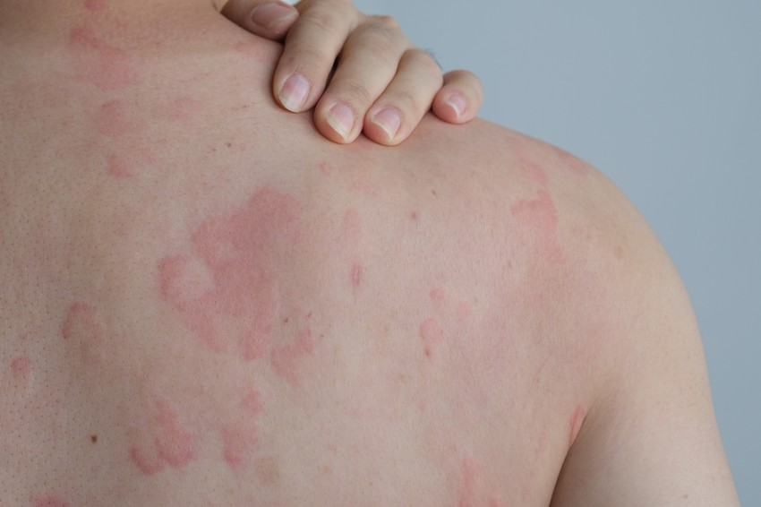 A zavaró tünet, mely akár heteken-hónapokon át is jelentkezhet, a test bármely pontján megjelenhet.