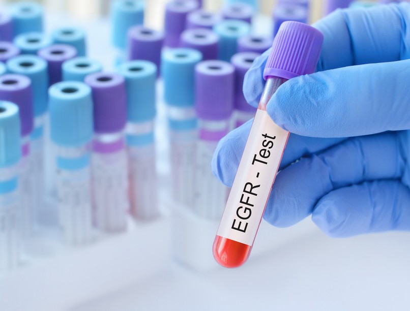 Mit jelent eGFR érték laborlelet