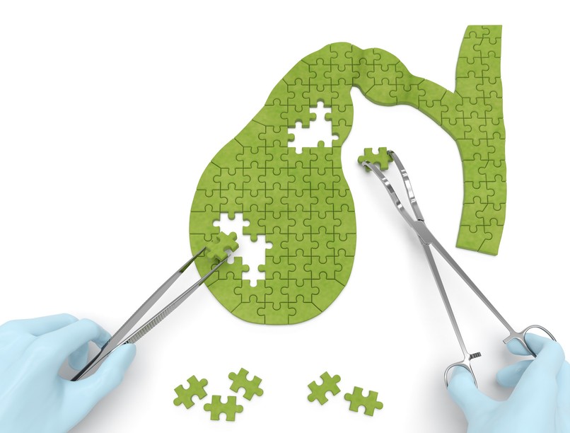 epekő eltávolítás enni diéta mikor