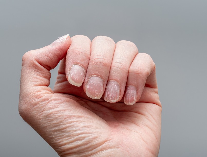 köröm milyen betegségre utal