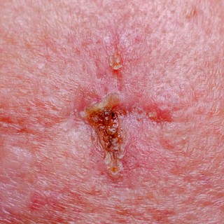 Kezdetben egyszerű sebnek tűnhet, pedig bőrrák: szokatlan tünetek is figyelmeztethetnek basaliomára című cikk nyitóképe