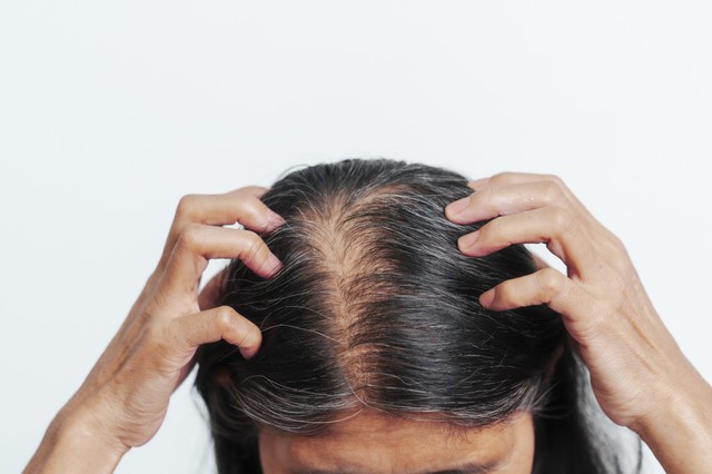 Miért hullik a hajam? Rejtett gyulladás és hormonzavar is okozhatja