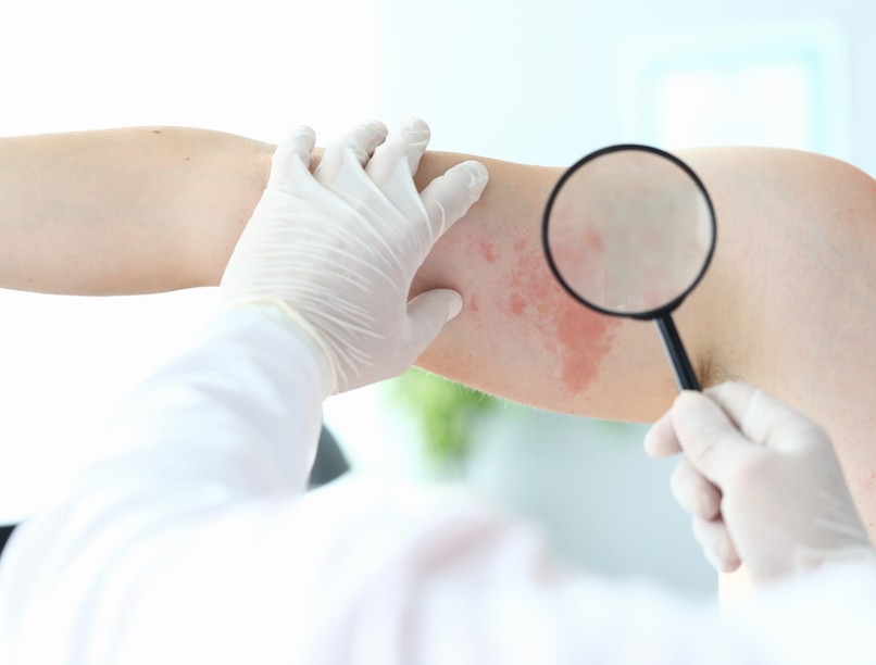 bőrgomba, gombás bőrfertőzés, bőrbetegség, bőrfertőzés, gombás fertőzés, viszketés, hámlás, tinea, dermatofita, lábgomba, körömgomba, atlétaláb, bőrgyulladás, cellulitis, orbánc, fejbőr, napgomba, korpásodás, faggyútermelés